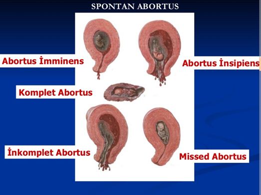 Hasil gambar untuk ABORTUS